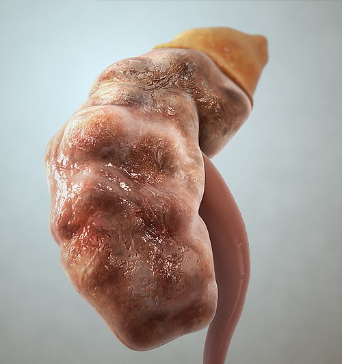 End-Stage Renal Disease